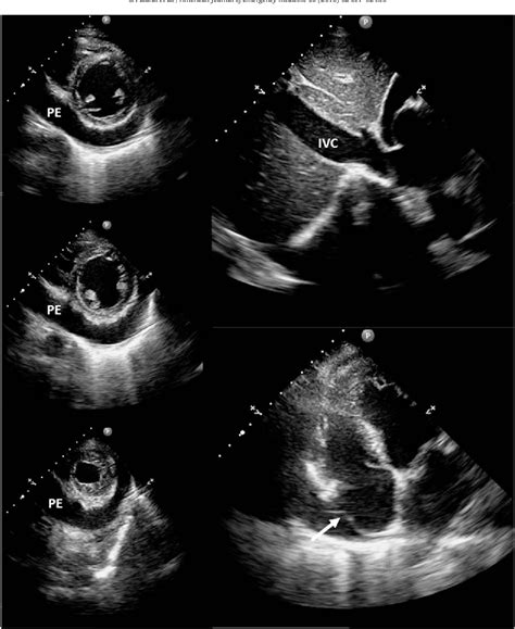 Figure 1 From Transitory Effusiveconstrictive Pericarditis Semantic