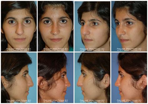 Ethnic Nose Surgery Before and After Photo Gallery - Nose Surgery Photos