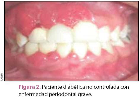 Enfermedad Periodontal Y Diabetes Mellitus Influencia Bidireccional