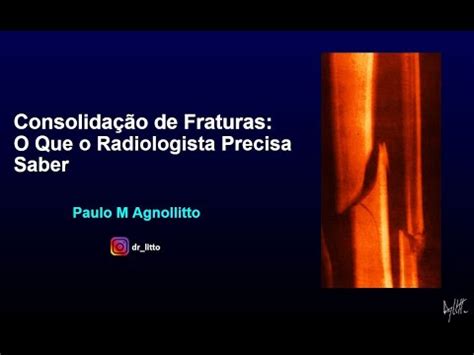 CONSOLIDAÇÃO DE FRATURAS O QUE O RADIOLOGISTA PRECISA SABER YouTube