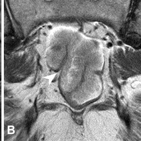 Illustration Of Rectal Wall Layers On High Resolution T2 Weighted Mri