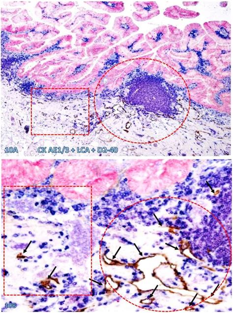 Tumor Infiltrating Immune Cells Triggers For Tumor Capsule Disruption