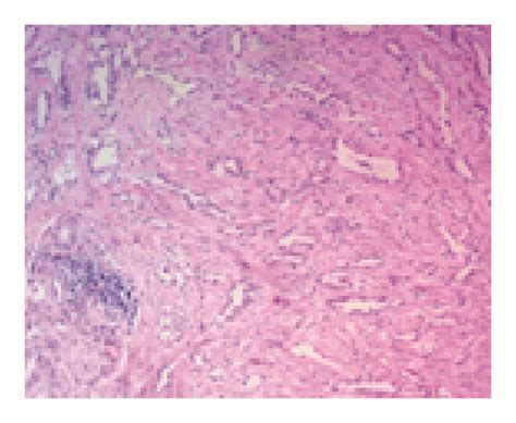 Epididymal Adenomatoid Tumor A Very Rare Paratesticular Tumor Of