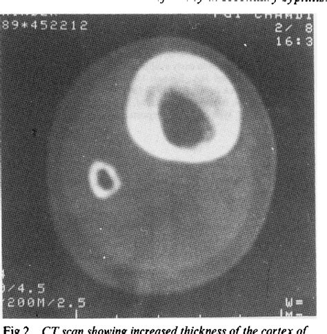 Pdf Bilateral Sabre Like Tibial Deformity In Secondary Syphilis Case