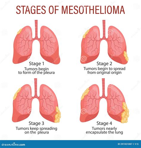 Stages Of Mesothelioma Lung Disease Healthcare Stock Illustration Illustration Of System