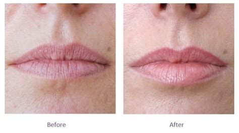 Dry Skin On Lips After Fillers And Surgery Lipstutorial Org