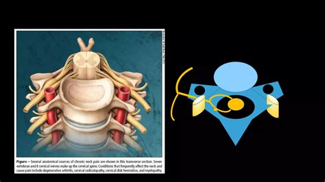 Cervical Radiculopathy Ppt