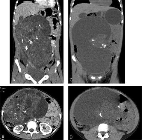 Grade 3 Immature Teratoma Of The Right Ovary In A 12 Year Old Girl And