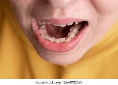 Curved Female Teeth Before Installing Braces Stock Photo 2264032585