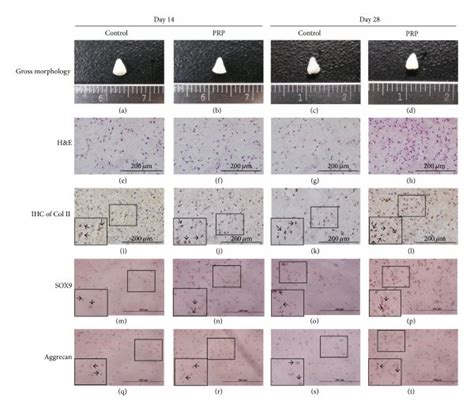 Engineered Auricle Tissue By Microtia Chondrocytes Reconstructed In 3D