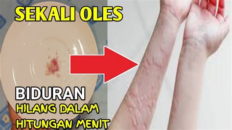 OBAT HERBAL BIDURAN PALING AMPUH CARA MENGATASI BIDURAN SECARA ALAMI