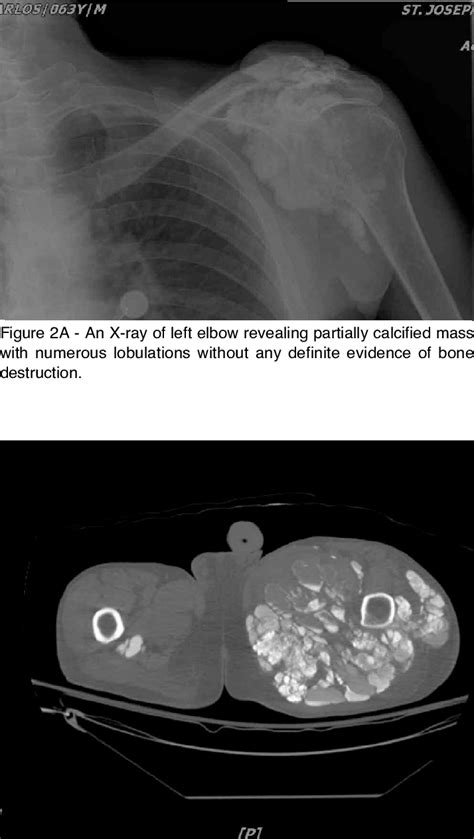 B Ct Scan Of The Left Thigh Showed Soft Tissue Calcified Masses