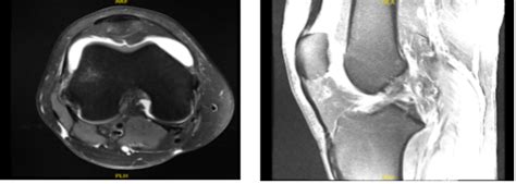 Case Study Knee Arthroscopy Acl Reconstruction Using Quadriceps