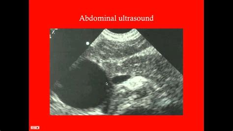 Pancreatic Pseudocyst Ultrasound