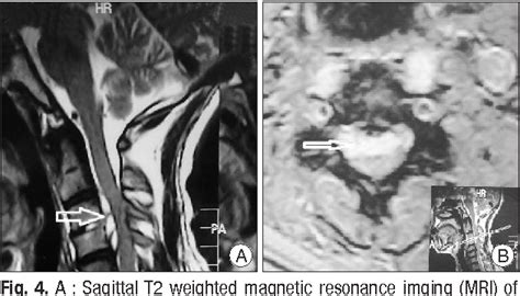 [pdf] Surgical Management Of Cervical Spinal Epidural Abscess Caused By