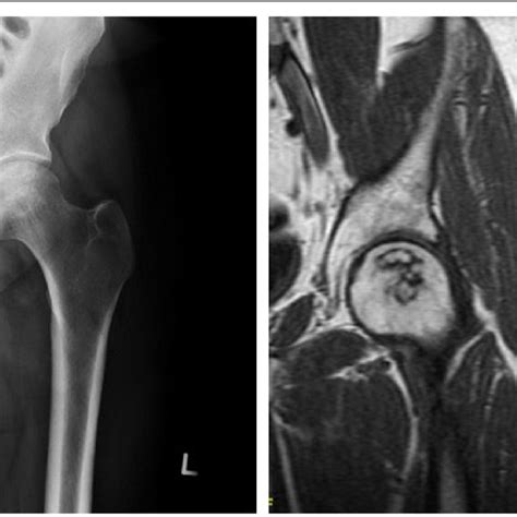 Plain Ap Pelvis X Ray At Years Follow Up Of A Patient With A Stage