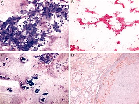 A Fna Smears Revealed Monotonous Cell Population Of Oncocytic Cells Download Scientific