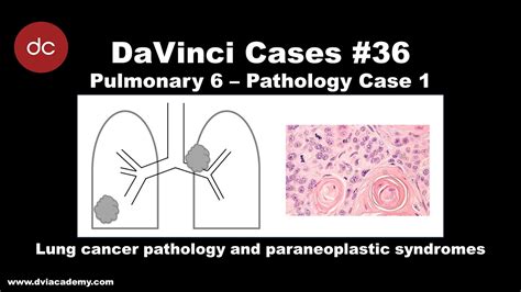 Lung Cancer And Paraneoplastic Syndromes Case [ Davincicases Pulmonary