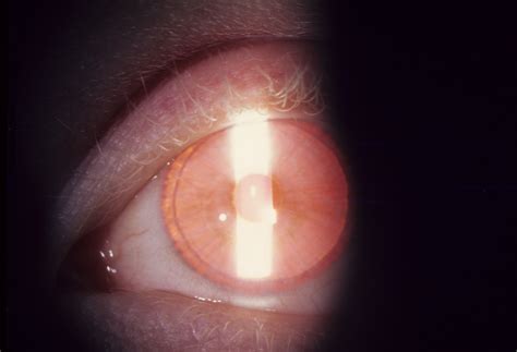 Albinism Oculocutaneous Type I Hereditary Ocular Diseases