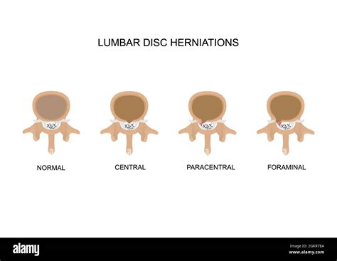 Lumbar Disc Herniation Types