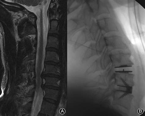 Anterior Cervical Discectomy And Fusion Acdfdisc Replacement Hybrid