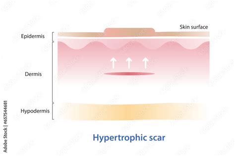 Hypertrophic Scar On Skin Surface Vector Illustration Isolated On White