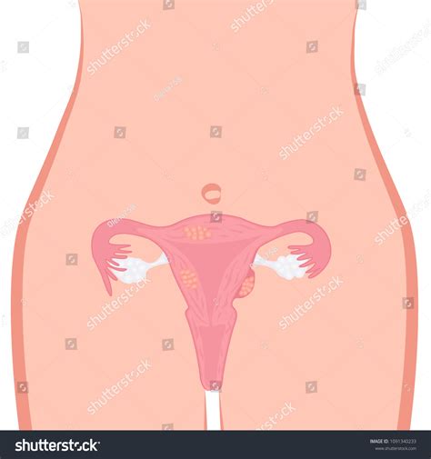 Uterine Fibroid Vector Illustration Gynecology Problem Stock Vector