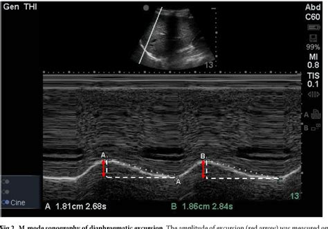 Pdf Changes Of Diaphragmatic Excursion And Lung Compliance During