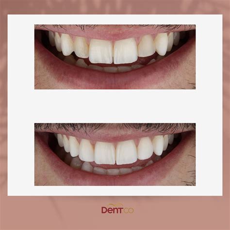 Teeth Whitening Turkey Dentco