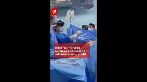 Brasil faz 1ª cirurgia de retirada de tumor no pulmão recursos 3D