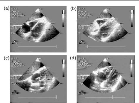 Figure From Echocardiography Guided Versus Fluoroscopy Guided