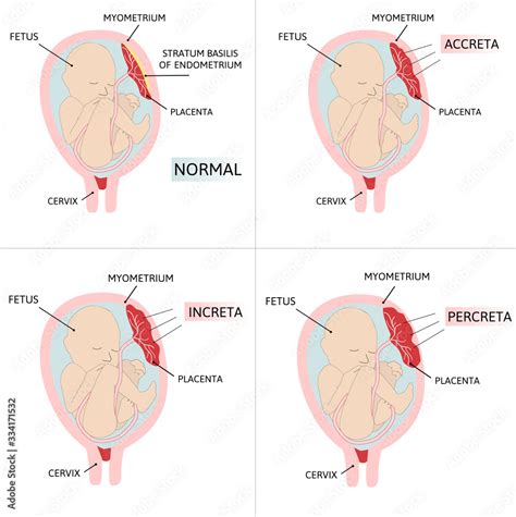 Diagramme Du Placenta Accreta