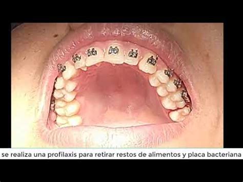 Ajuste De Brackets Todo Lo Que Necesitas Saber Ortodoncia Junin