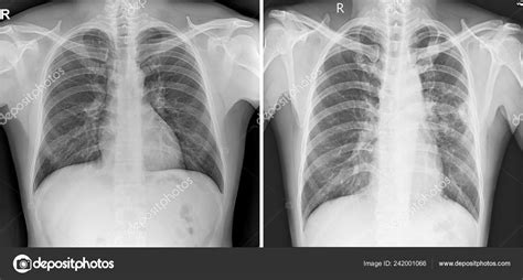 Abnormal Chest X Ray Results