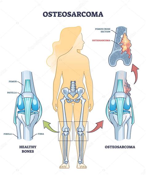 Tumor Seo Del Osteosarcoma Como Sarcoma Osteog Nico Esquema Del