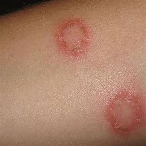 Common Fungal Skin Infections