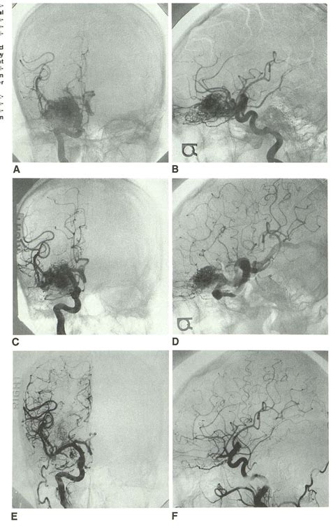 Figure 1 From Treatment Of Arteriovenous Malformations Of The Brain With Combined Embolization