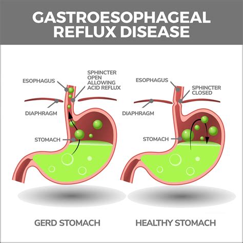 What Is Esophagitis Gastroenterology Of Greater Orlando