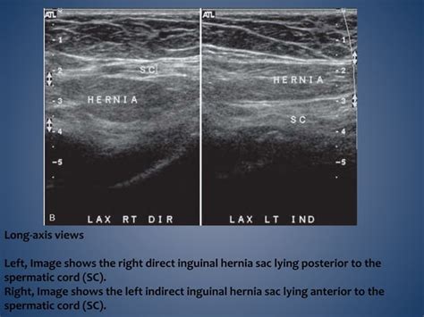 Imaging Of Inguino Scrotal Region PPT