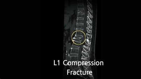 Lumbar Fracture Types