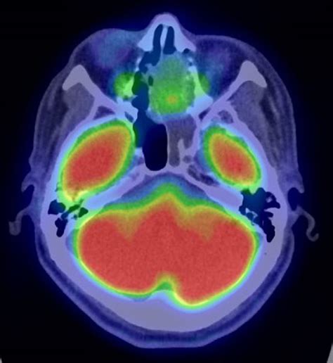 Figure From Imaging Features Of A Myoepithelial Carcinoma Of The