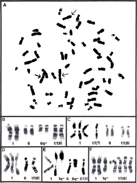 Representative Examples Of G Banded Cells From Five Cases Of Melanoma Download Scientific