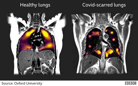 Covid-19: Lung damage 'identified' in study