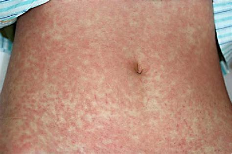 An Adult Case Of Kawasaki Disease In A Pregnant Japanese Woman A Case