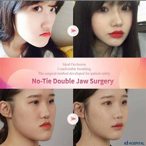 Albums Pictures Jaw Surgery Overbite Before And After Pictures Latest