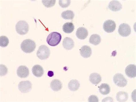 Erythrocyte Inclusions StatPearls NCBI Bookshelf