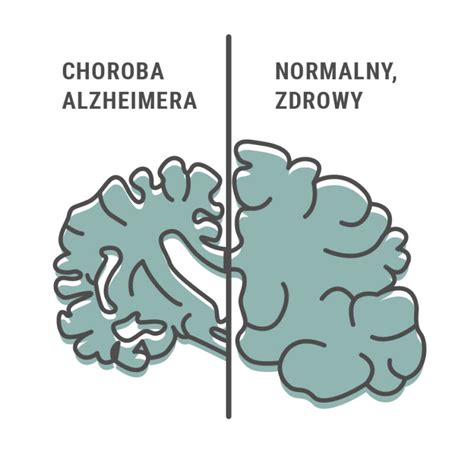 Choroba Alzheimera Przyczyny I Objawy Bedenefin