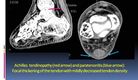 Ankle Tendons Mri Hot Sex Picture