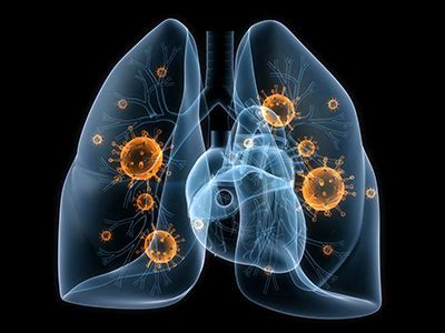 Pneumocystis Pneumonie Ursachen Symptome Behandlung MedLexi De