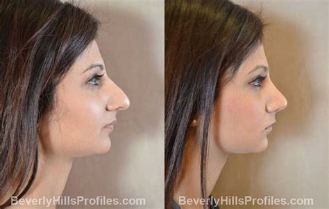 Rhinoplasty Before And After Photo Gallery